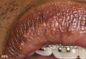 fordyce spots