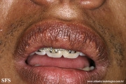 fordyce spots