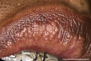 fordyce spots