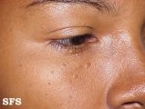 syringoma