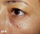 syringoma