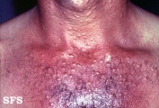 syringoma