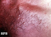 syringoma