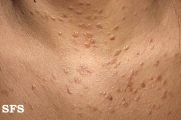 syringoma