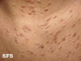 syringoma