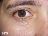 syringoma