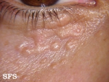 syringoma