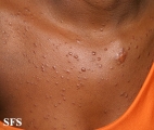 syringoma