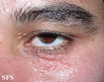 syringoma