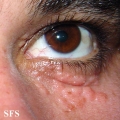 syringoma