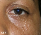 syringoma