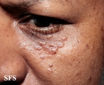 syringoma