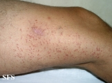 syringoma