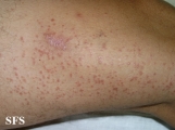 syringoma