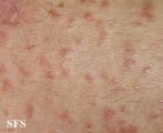 syringoma
