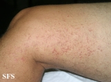 syringoma