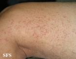 syringoma