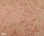 syringoma