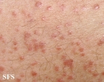 syringoma