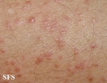 syringoma