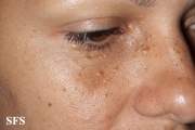 syringoma