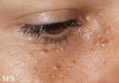 syringoma
