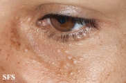 syringoma