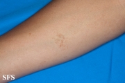 syringoma
