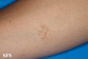 syringoma