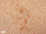 syringoma