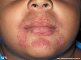 perioral dermatitis