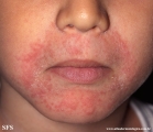 perioral dermatitis