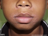 perioral dermatitis