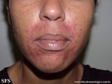 perioral dermatitis