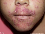 perioral dermatitis
