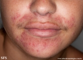 perioral dermatitis