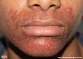 perioral dermatitis