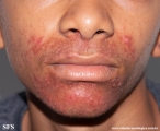 perioral dermatitis