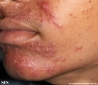 perioral dermatitis