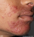 perioral dermatitis