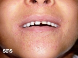 perioral dermatitis