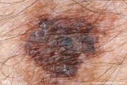 melanoma_associated_witch_seborrheica_keratosis