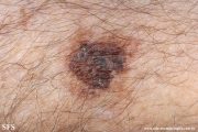 melanoma_associated_witch_seborrheica_keratosis