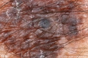 melanoma_associated_witch_seborrheica_keratosis