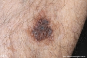 melanoma_associated_witch_seborrheica_keratosis