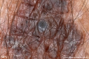 melanoma_associated_witch_seborrheica_keratosis