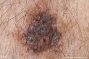 melanoma_associated_witch_seborrheica_keratosis