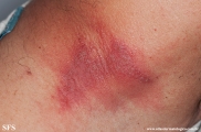 paederus dermatitis