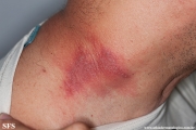 paederus dermatitis