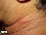 paederus dermatitis
